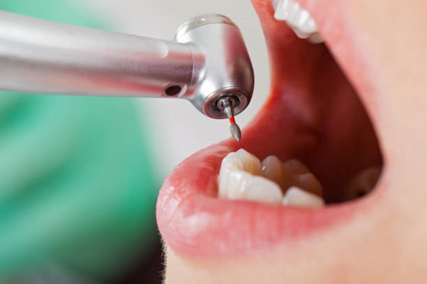 Best Emergency Dentist for Knocked-Out Tooth in Shelton, WA